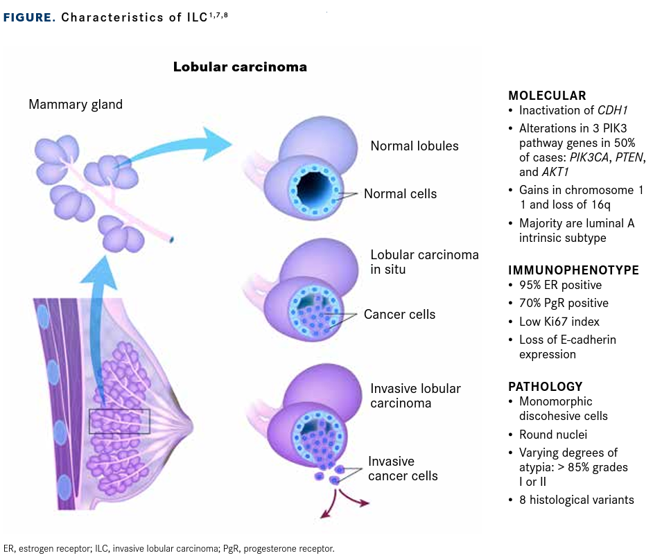 Lobular Invasive Lobular Carcinoma Comes Into Sharper Focus