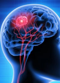 Temferon in newly diagnosed glioblastoma multiforme|   Image Credit: © peterschreiber.media - stock.adobe.com