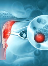 Endometrial Cancer | Image Credit: © Crystal Light - stock.adobe.com