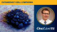 Brad Haverkos, MD, discusses approaches for the management of mogamulizumab-associated rash in patients with cutaneous T-cell lymphoma.