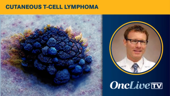 Brad Haverkos, MD, discusses approaches for the management of mogamulizumab-associated rash in patients with cutaneous T-cell lymphoma.