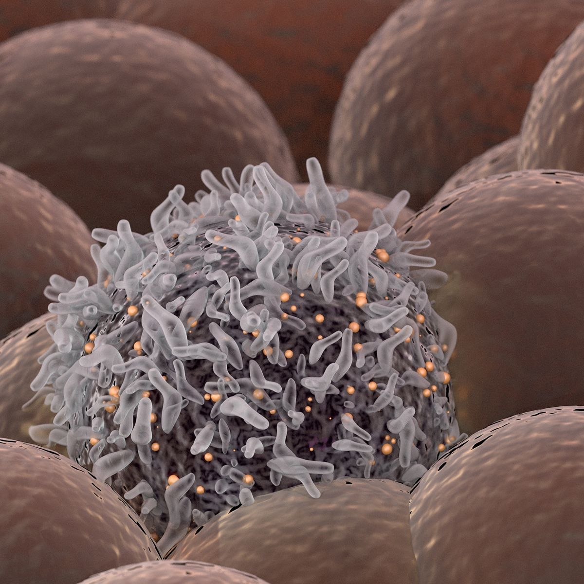 melanoma