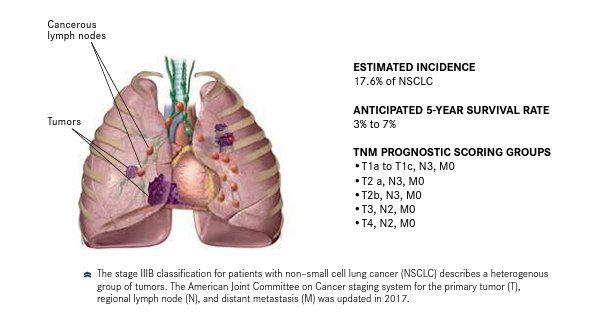 Figure. Illustration of Lung Cancer at Stage IIIB4