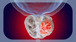 CaRe Prostate Study of INKmune in Metastatic CRPC Hits Primary, Secondary End Points