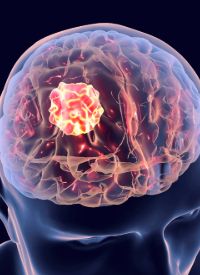 NF1-Associated PNs | Image Credit: © Dr_Microbe - stock.adobe.com