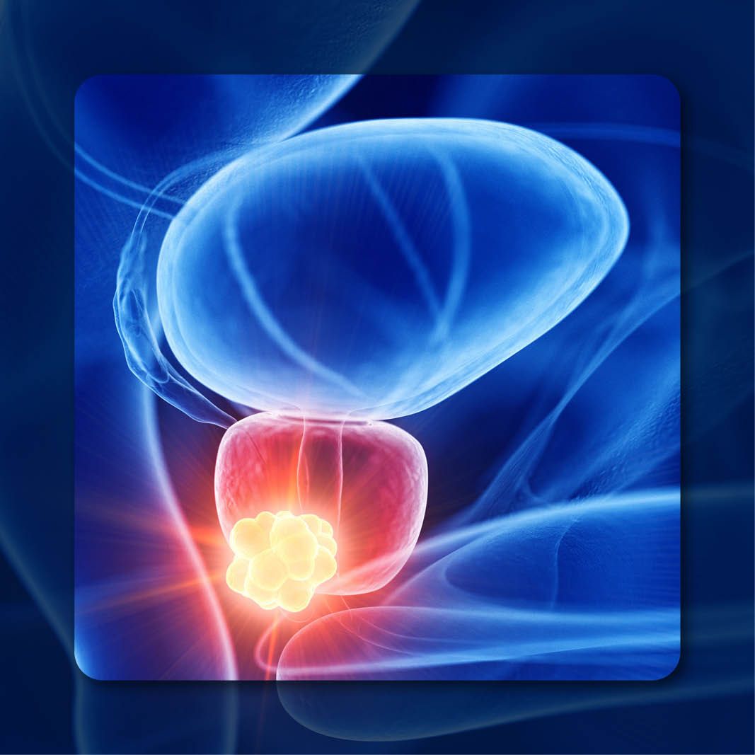 Prostate Cancer | Image Credit: © Sebastian Kaulitzki – stock.adobe.com