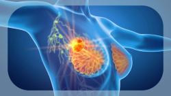 Health Canada Approves Adjuvant Ribociclib for HR+/HER2– Early Breast Cancer