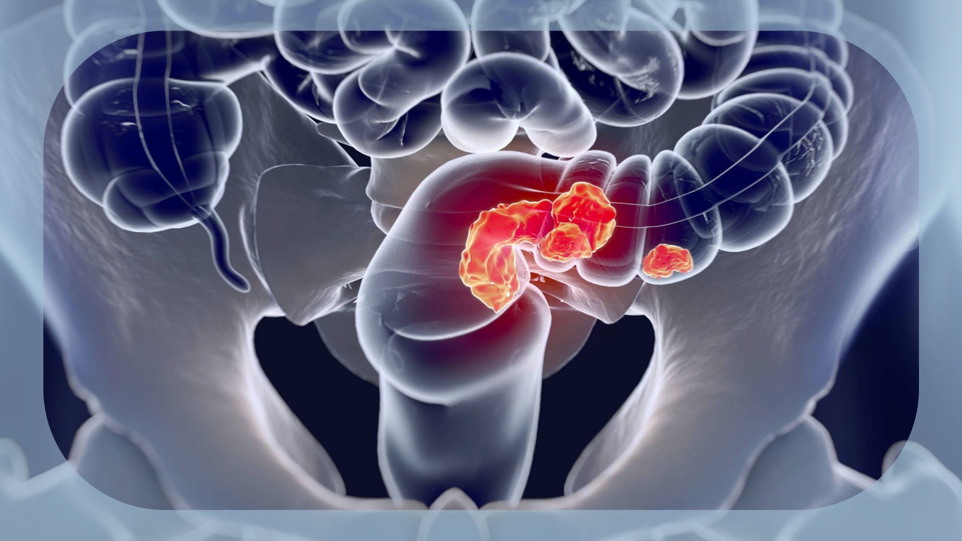 Colorectal Cancer | Image credit:   © Anatomy Insider - stock.adobe.com