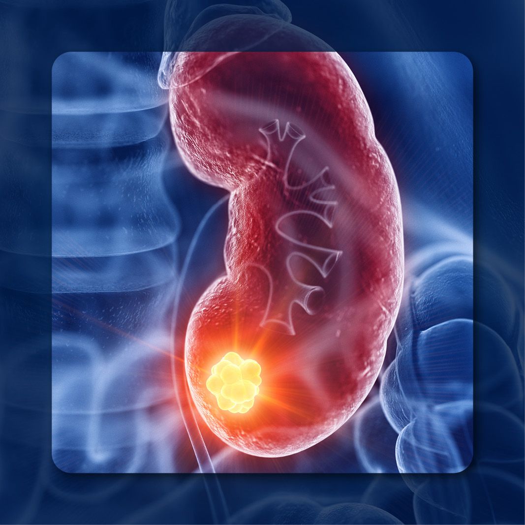 Real-World Data Support the Frontline Use of Avelumab Plus Axitinib in ...