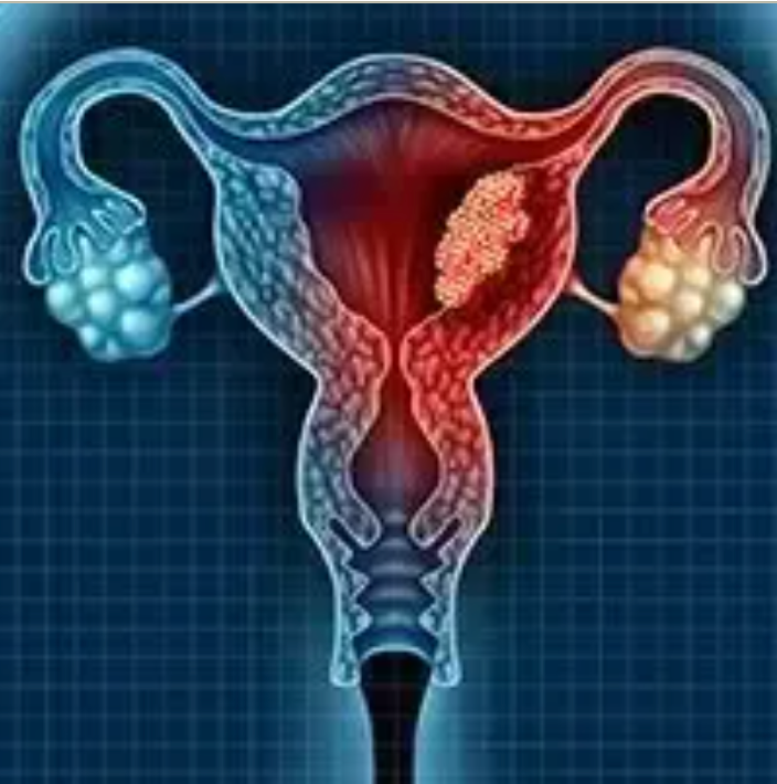 Ovarian Cancer
