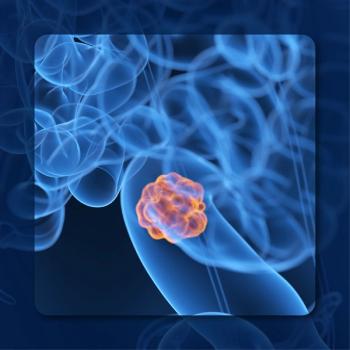 Organ Preservation Decisions in Rectal Cancer | Image Credit: © Sebastian Kaulitzki – stock.adobe.com