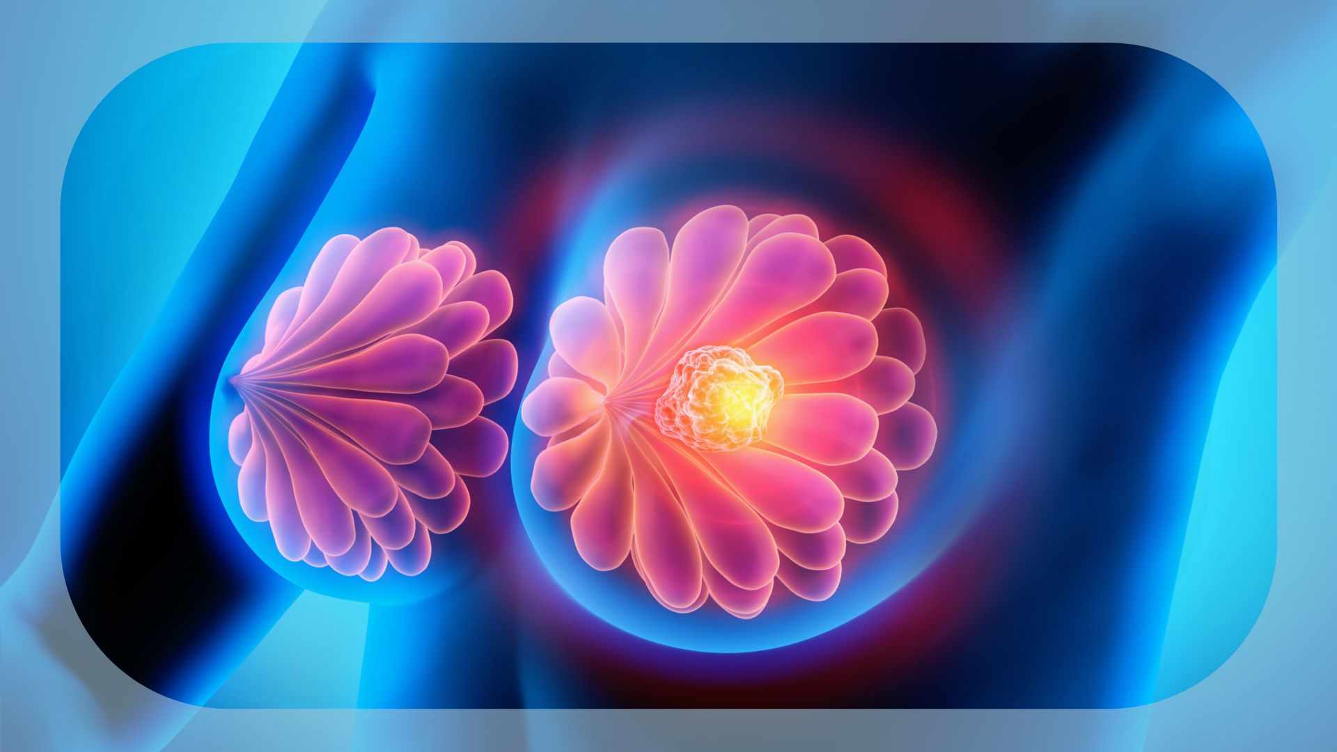 Vepdegestrant in ESR1-Mutated, ER+/HER2– Metastatic Breast Cancer | Image Credit: © peterschreiber.media - stock.adobe.com