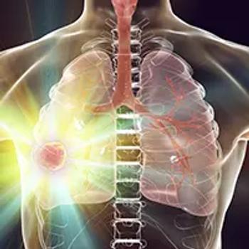 Amivantamab in NSCLC | Image Credit: © Dr_Microbe - stock.adobe.com