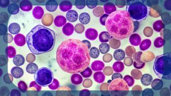 B-Cell Lymphoma | Image Credit: © Curie - stock.adobe.com