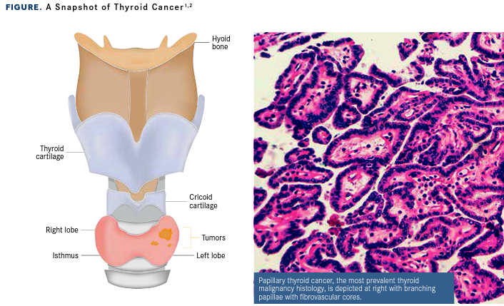 Ｔｈｙｒｏｉｄ　Ｃａｎｃｅｒ　Ｅｘｐｌｏｒｅ ｖｏｌ．３　ｎｏ．２（２２０１/メディカルレビュ-社/「Ｔｈｙｒｏｉｄ　Ｃａｎｃｅｒ　Ｅｘｐｌ（大型本） Thyroid Cancer Explore vol．3 no