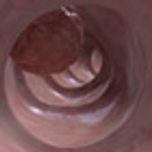 Noninvasive Stool Test Effectively Detects Colon Cancer