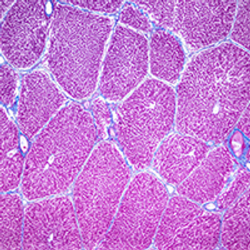 hepatocellular carcinoma