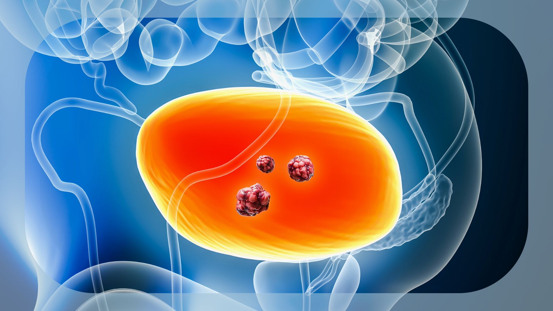 Nogapendekin Alfa Inbakicept Plus BCG Approved in UK for BCG-Unresponsive NMIBC With CIS