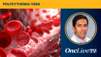 Pankit Vachhani, MD, discusses data that have read out for sapablursen in the treatment of patients with polycythemia vera.