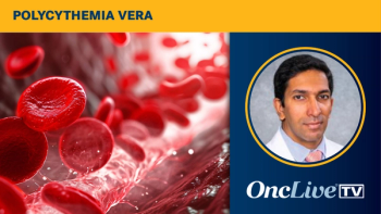 Pankit Vachhani, MD, discusses data that have read out for sapablursen in the treatment of patients with polycythemia vera.