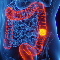3D rendered Medical Illustration of Male Anatomy - Colon Cancer; Descending Colon. | Image Credit: © Sebastian Kaulitzki - stock.adobe.com
