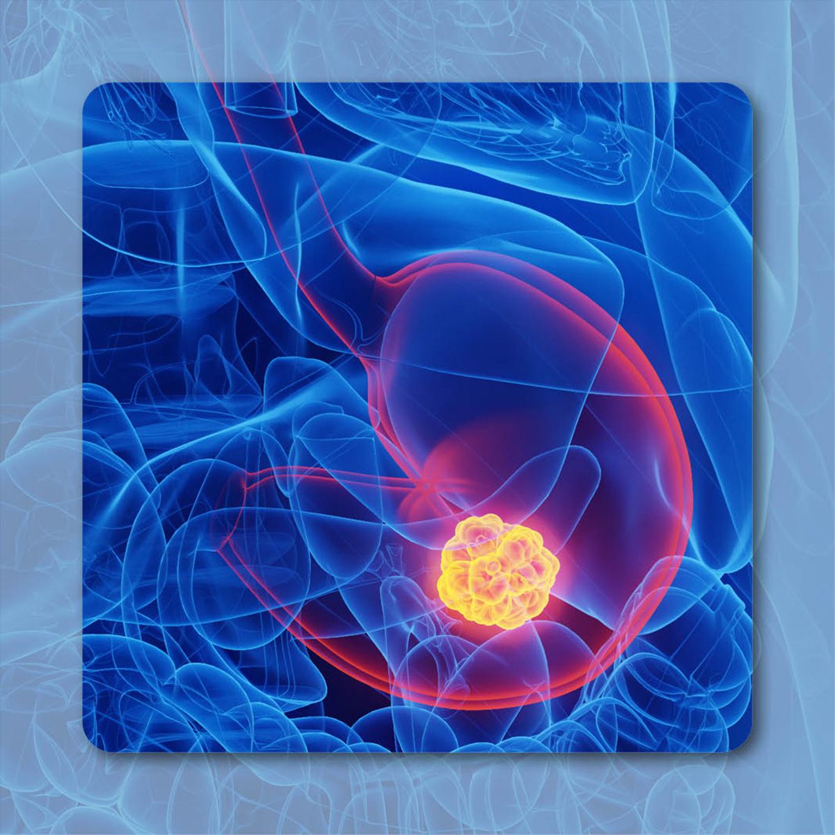 Gastrointestinal Cancer |  Image credit: © Sebastian Kaulitzki  – stock.adobe.com