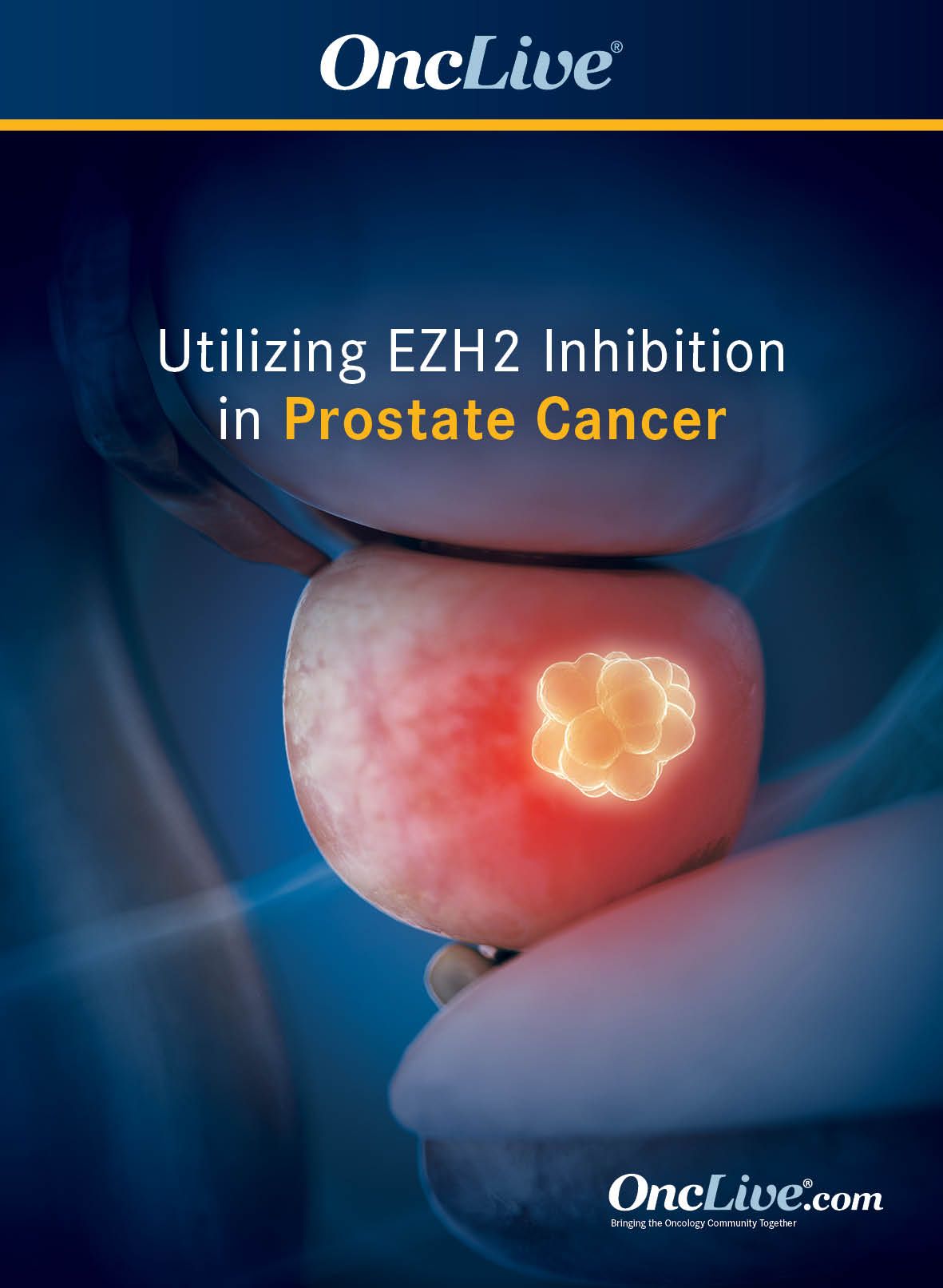 Utilizing EZH2 Inhibition in Prostate Cancer