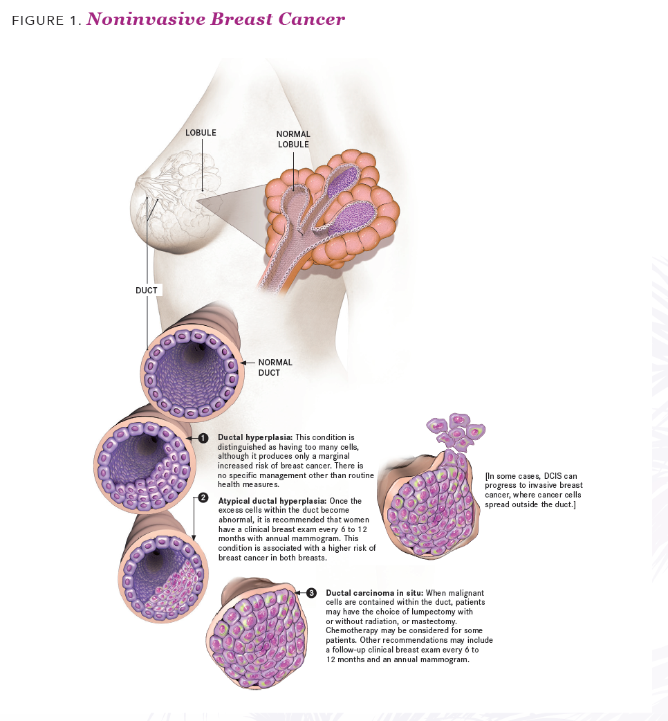 Navigating Treatment Options For Patients With Early Stage Breast Cancer