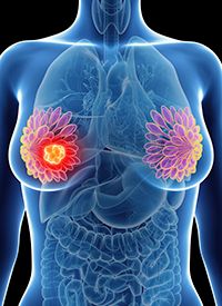 Breast Cancer Image
