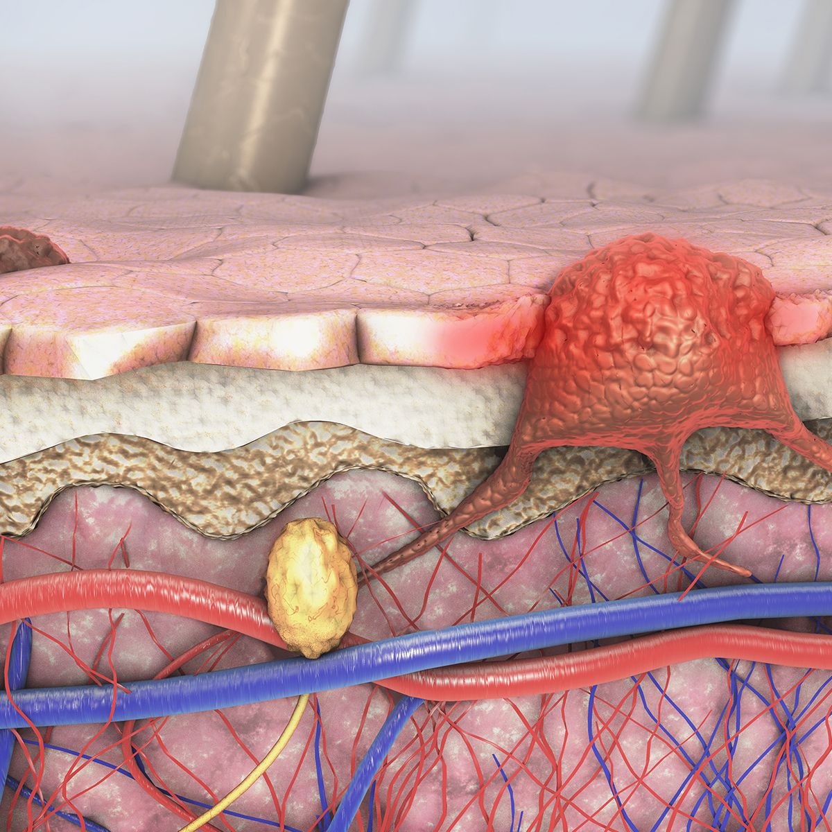melanoma