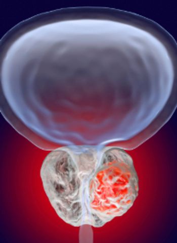 Prostate Cancer | Dr_Microbe - stock.adobe.com