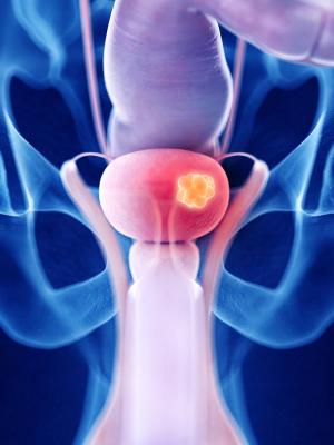 Extending Overall Survival in Patients with Advanced Urothelial Carcinoma