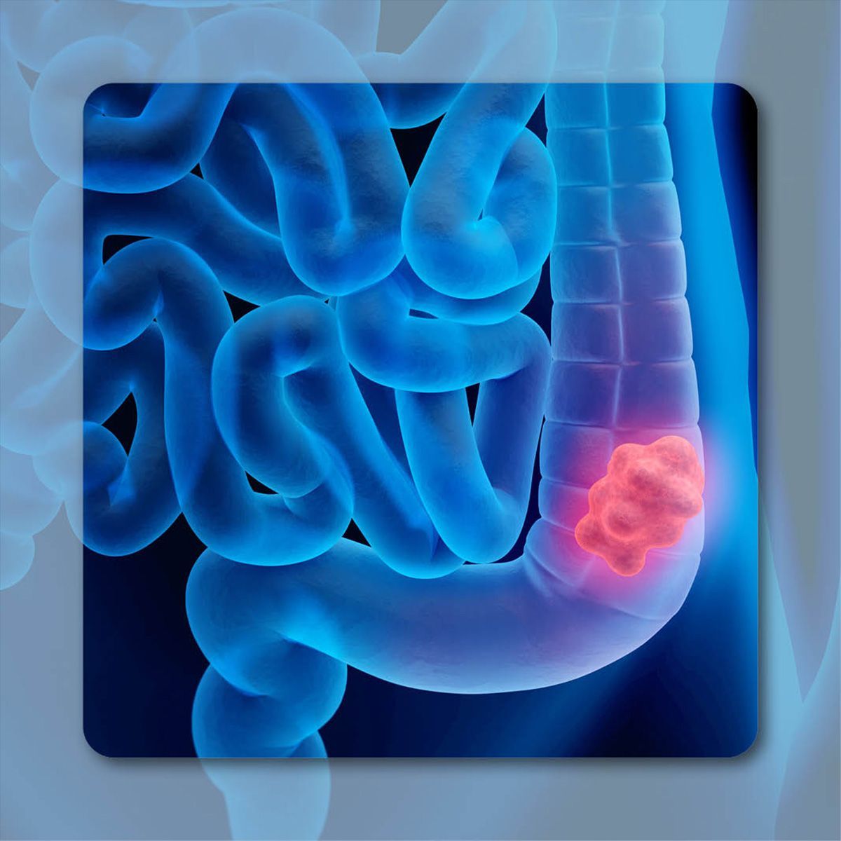 Cetuximab β Plus FOLFIRI in First-Line mCRC | Image Credit: © peterschreiber.media – stock.adobe.com