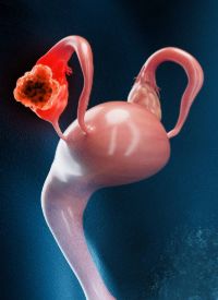 Raludotatug Deruxtecan in Ovarian  Cancer | Image Credit: ©Sebastian Kaulitzki -  stock.adobe.com