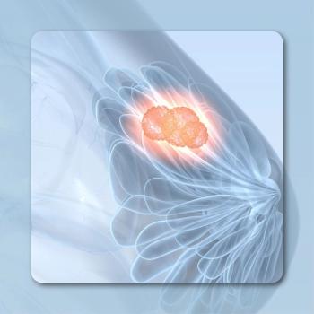 Breast cancer- stock.adobe.com