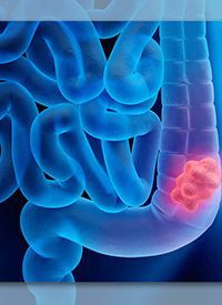 Rectal Cancer | Image Credit: © peterschreiber.com - stock.adobe.com