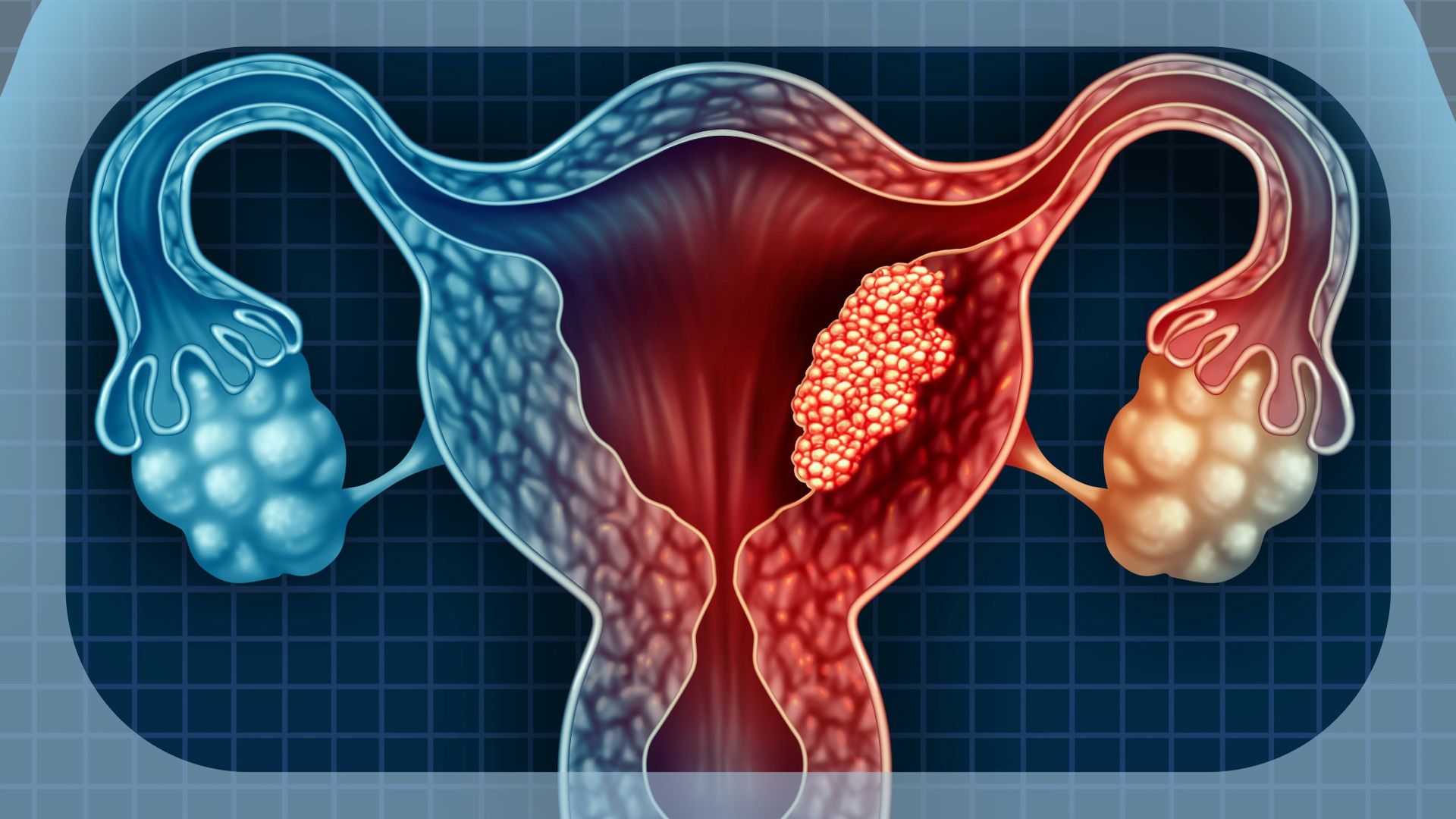 Cervical Cancer | Image Credit: © freshidea - stock.adobe.com