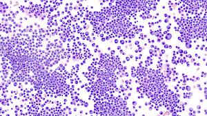 Image of multiple myeloma cells