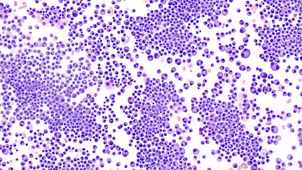 Image of multiple myeloma cells
