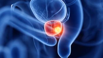 Graphic of a prostate with a tumor