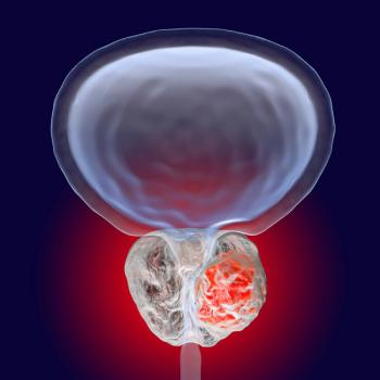 Graphic of a bladder and enlarged prostate with a tumor