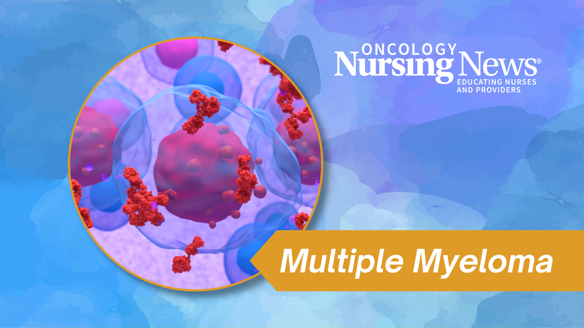 Graphic with a multiple myeloma visual and an Oncology Nursing News logo