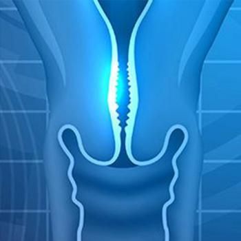Graphic of a the reproductive system with a cervical tumor