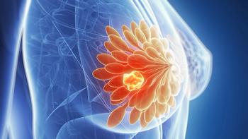 Blue image of a breast with tissue and a tumor highlighted in orange
