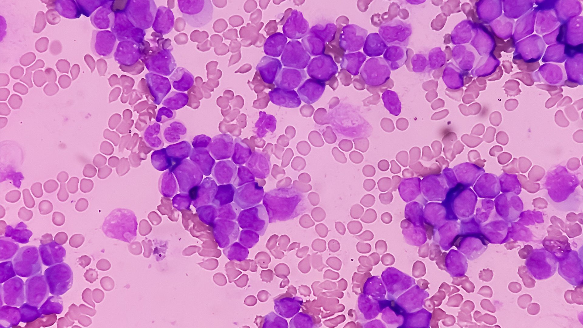 image of an acute myeloid leukemia cell