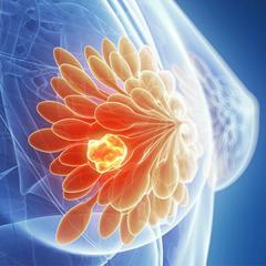 Anatomical image of a breast with a tumor