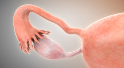 Nurses Play Key Role in Facilitating Maintenance Therapy With PARP Inhibitors in Ovarian Cancer