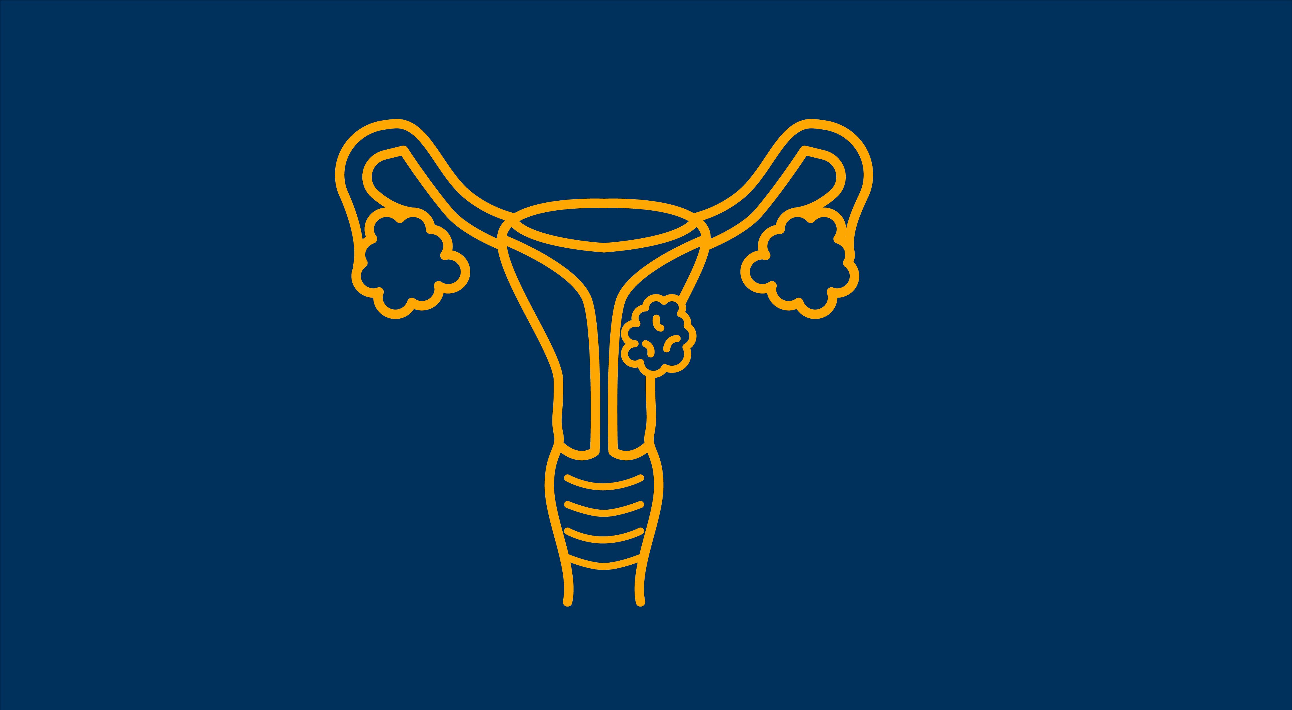 ovarian cancer