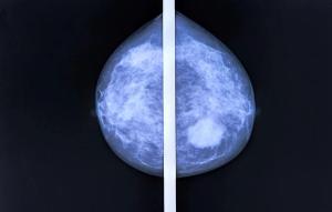 Breast Image