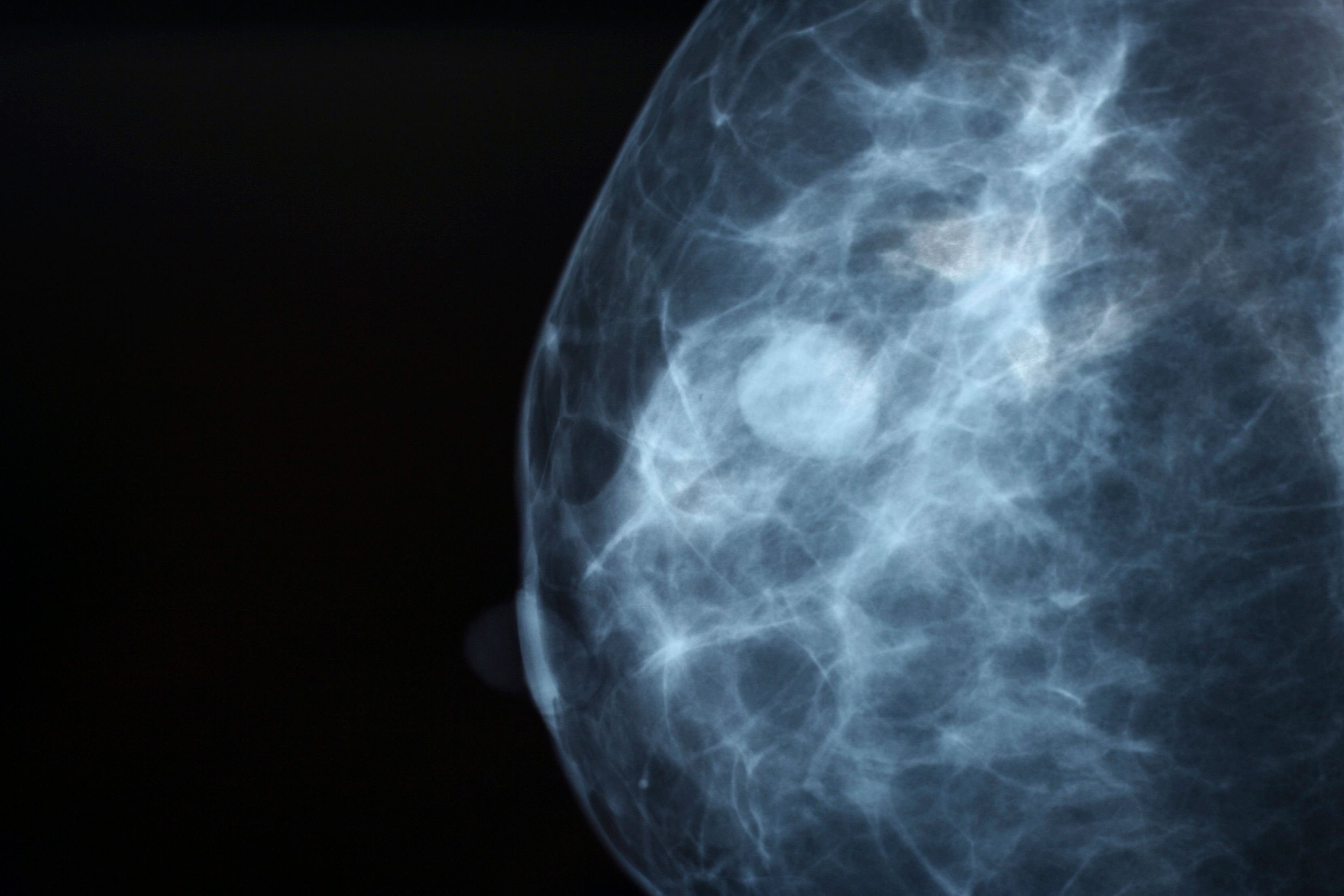На фоне фиброзных изменений. Фиброзно-кистозная мастопатия маммография. Фиброзная мастопатия маммограмма. Кистозная мастопатия маммография. Узловая мастопатия маммограмма.